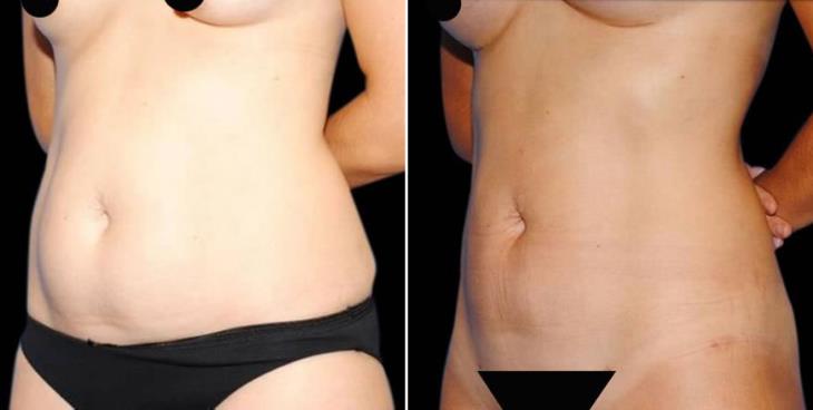 Liposuction Results Atlanta Side View