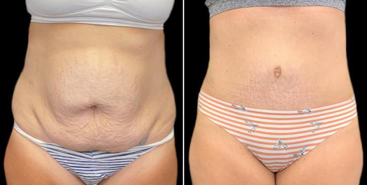 Results Of Tummy Tuck