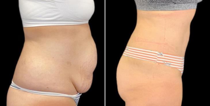Results Of Tummy Tuck Side View