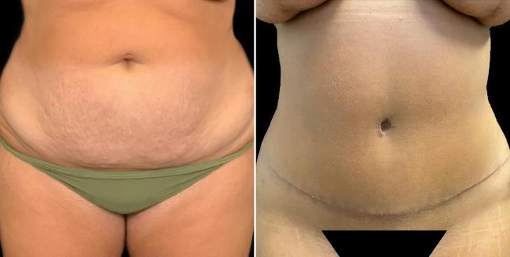 Tummy Tuck Results