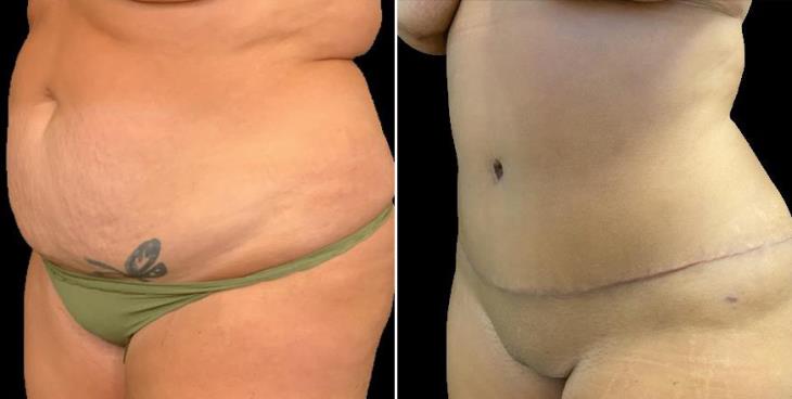 Tummy Tuck Results Side View