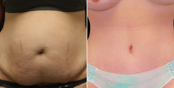 Tummy Tuck Results Georgia