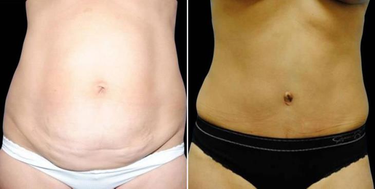 Georgia Tummy Tuck Results 