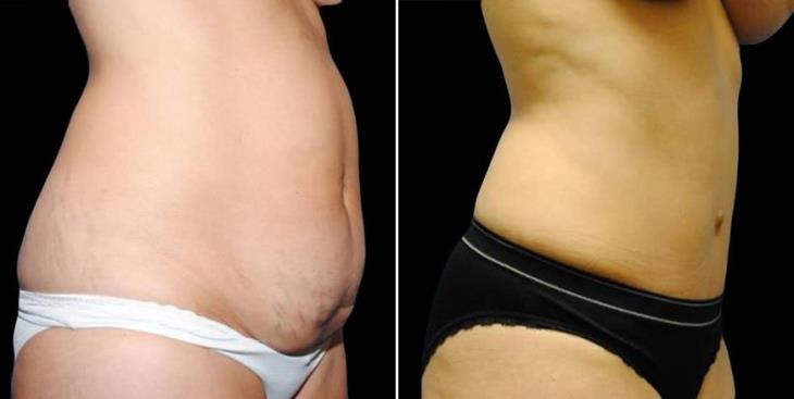 Georgia Tummy Tuck Results Side View