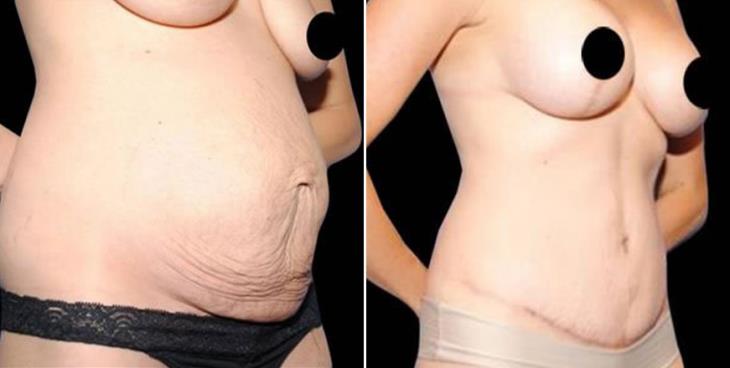 Tummy Tuck Results Atlanta GA Side View