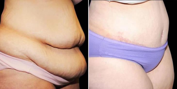 Atlanta GA Tummy Tuck Results Side View