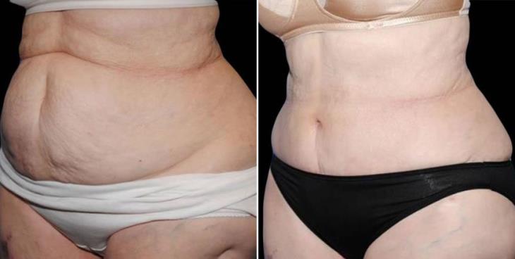 Before And After Tummy Tuck Side View
