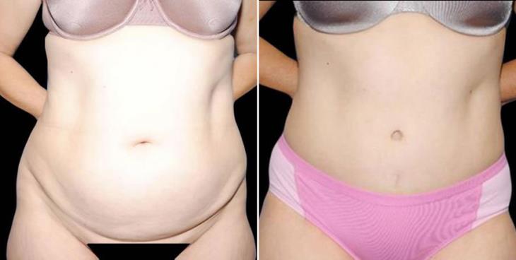 Abdominoplasty Surgery Results Marietta GA Front View