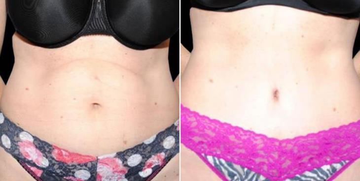 Before & After Tummy Tuck