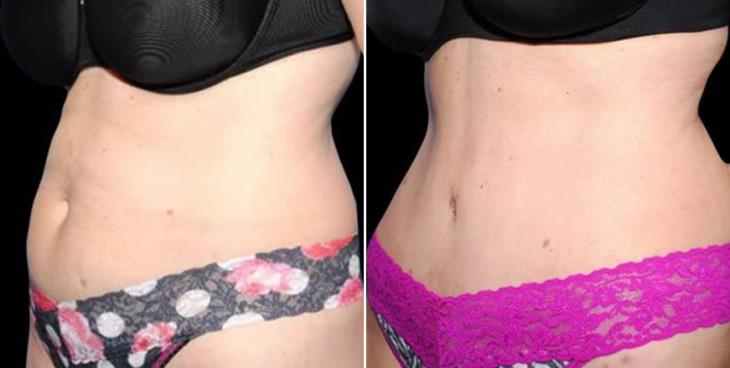 Before & After Tummy Tuck Side View