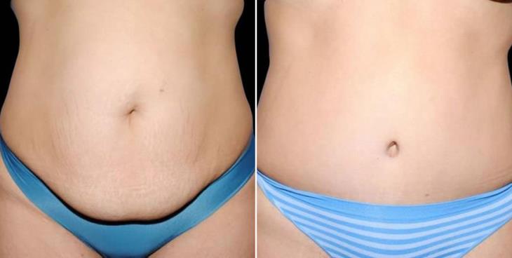 Tummy Tuck Before & After