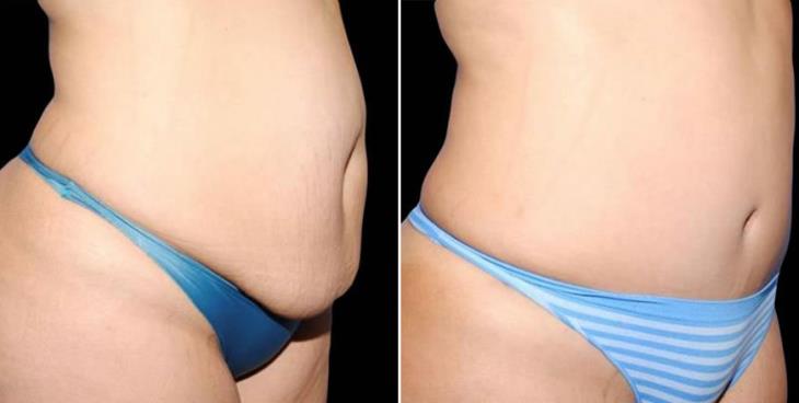 Tummy Tuck Before & After Side View