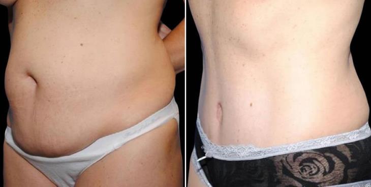 Tummy Tuck Before And After Atlanta Side View