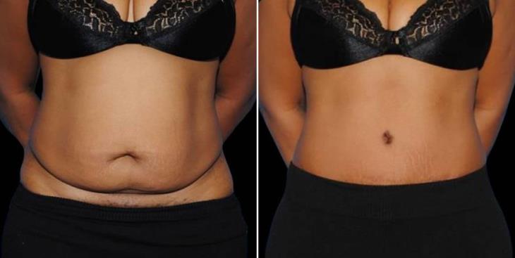 Before & After Tummy Tuck Atlanta