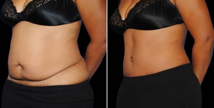 Before & After Tummy Tuck Atlanta Side View