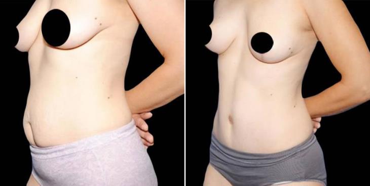 Tummy Tuck Before & After Atlanta Side View