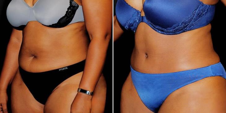 Abdominoplasty Results Side View