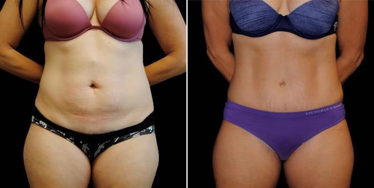 Results Of Abdominoplasty