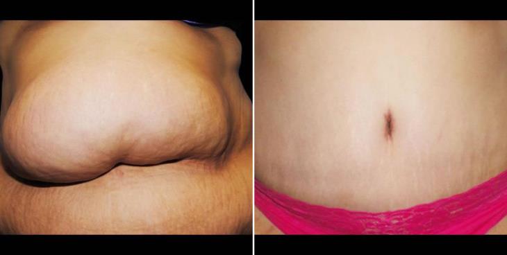 Abdominoplasty Results Atlanta