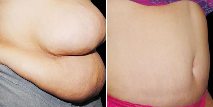 Abdominoplasty Results Atlanta Side View