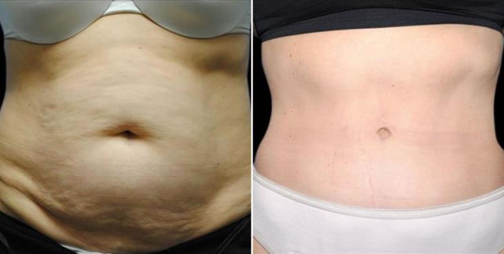 Results Of Abdominoplasty Atlanta