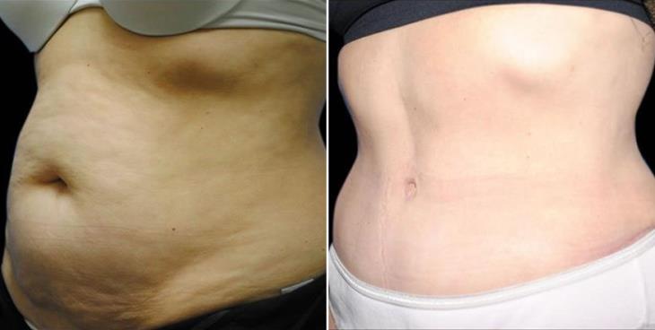 Results Of Abdominoplasty Atlanta Side View