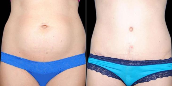 Abdominoplasty Results Atlanta Georgia