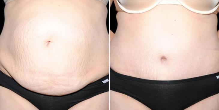 Results Of Abdominoplasty Atlanta Georgia