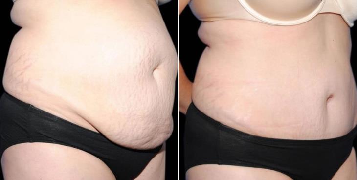 Results Of Abdominoplasty Atlanta Georgia Side View