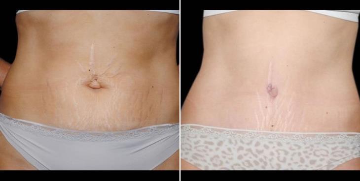 Abdominoplasty Results Atlanta GA