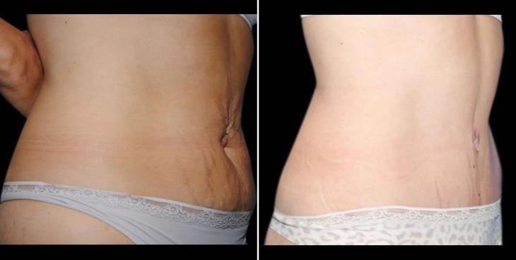 Abdominoplasty Results Atlanta GA Side View