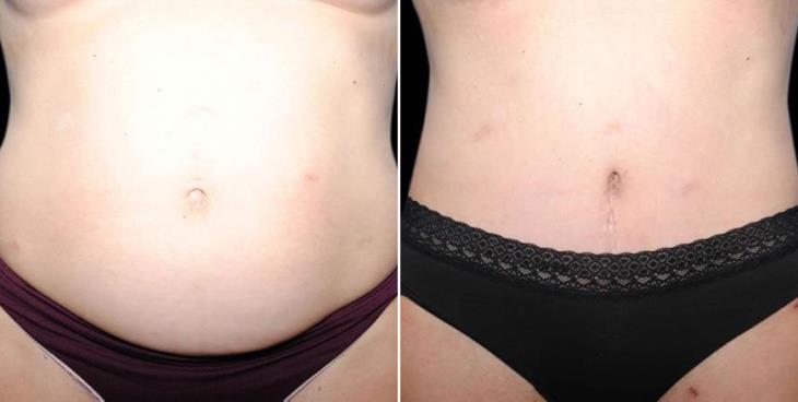 Atlanta GA Abdominoplasty Results