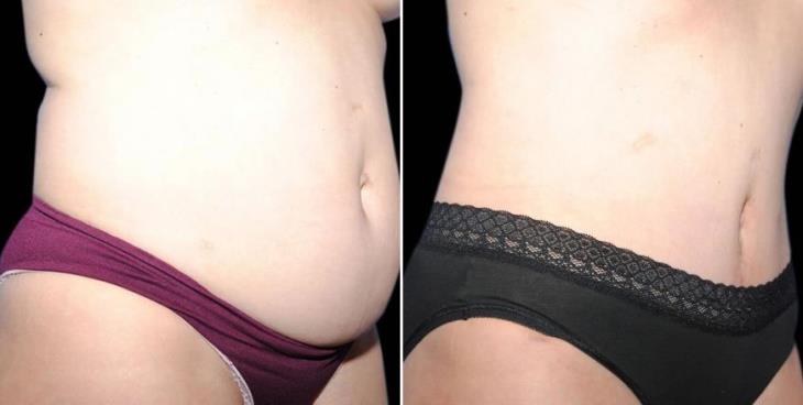 Atlanta GA Abdominoplasty Results Side View