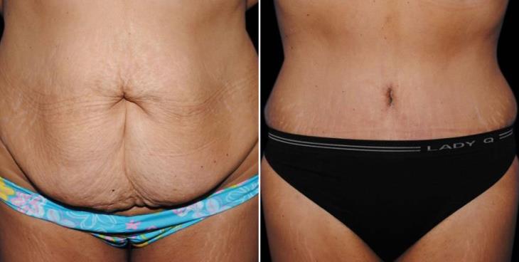 Atlanta Tummy Tuck Results