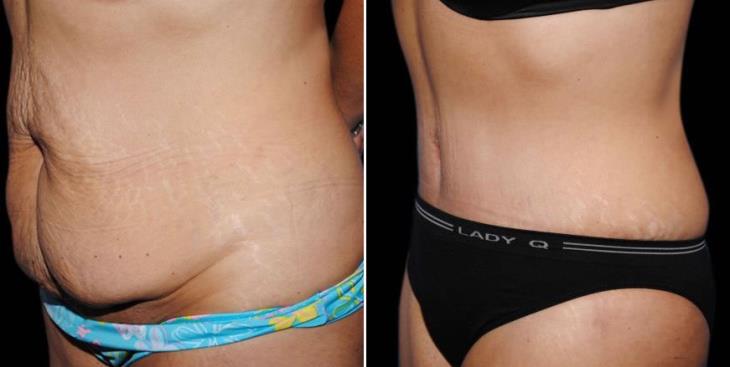 Atlanta Tummy Tuck Results Side View