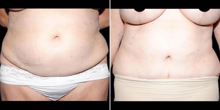 Before And After Atlanta Abdominoplasty