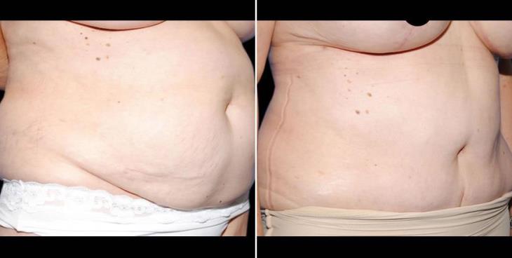 Before And After Atlanta Abdominoplasty Side View