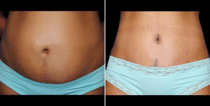 Atlanta Abdominoplasty Before And After