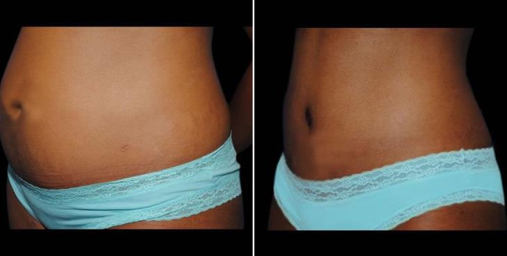 Atlanta Abdominoplasty Before And After Side View