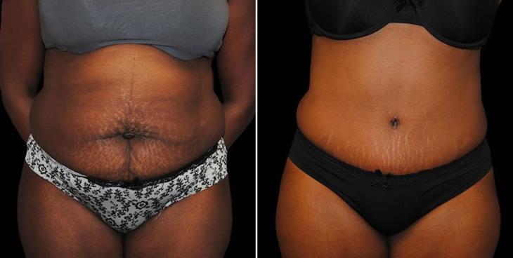 Before & After Atlanta Abdominoplasty