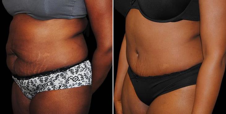 Before & After Atlanta Abdominoplasty Side View