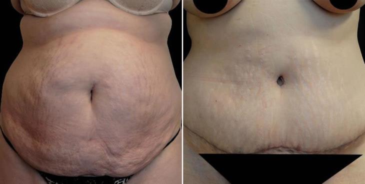 Atlanta Abdominoplasty Before & After