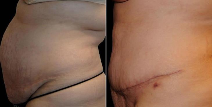 Atlanta Abdominoplasty Before & After Side View
