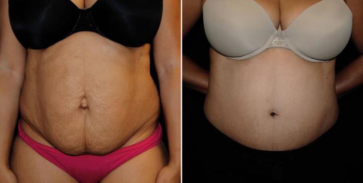 Tummy Tuck Results Atlanta