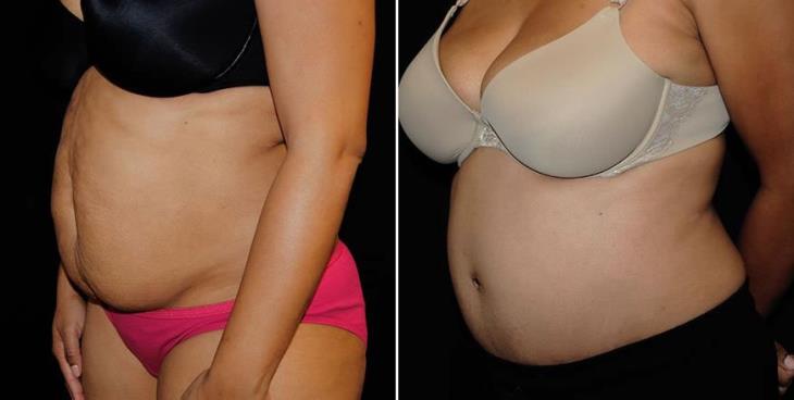 Tummy Tuck Results Atlanta Side View