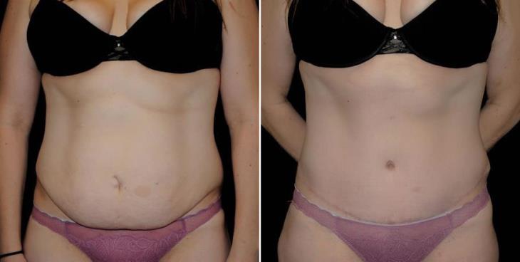 Before And After Georgia Abdominoplasty