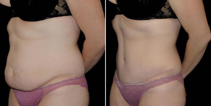 Before And After Georgia Abdominoplasty Side View