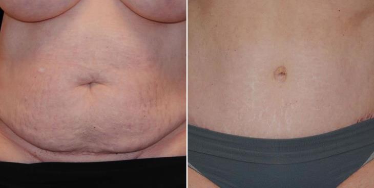 Georgia Abdominoplasty Before And After