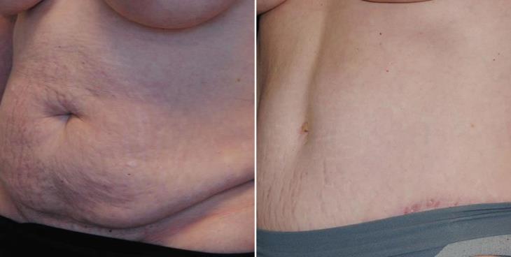 Georgia Abdominoplasty Before And After Side View