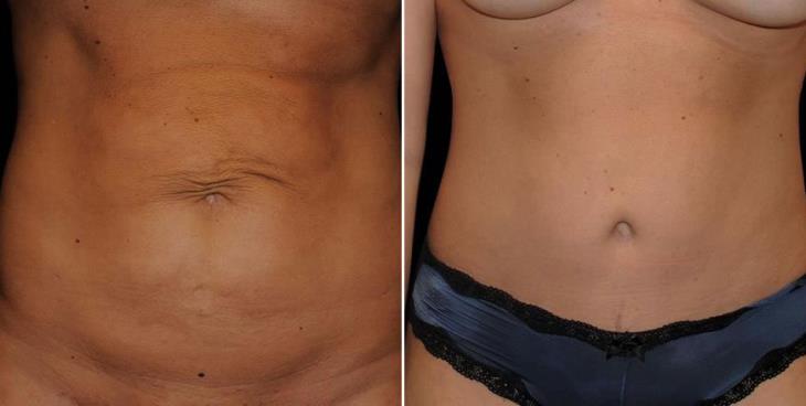 Before & After Georgia Abdominoplasty